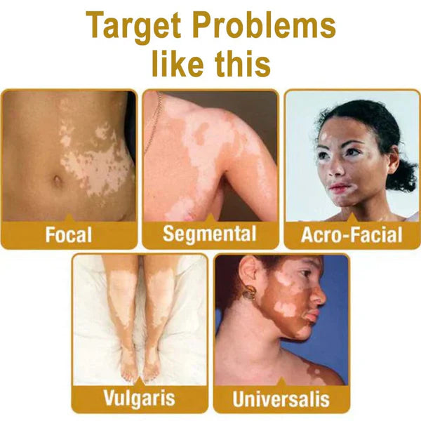 MD Vitigo™ Advanced Vitiligo Restore Cream ✨ | Buy 1 Get 1 Free 🔥